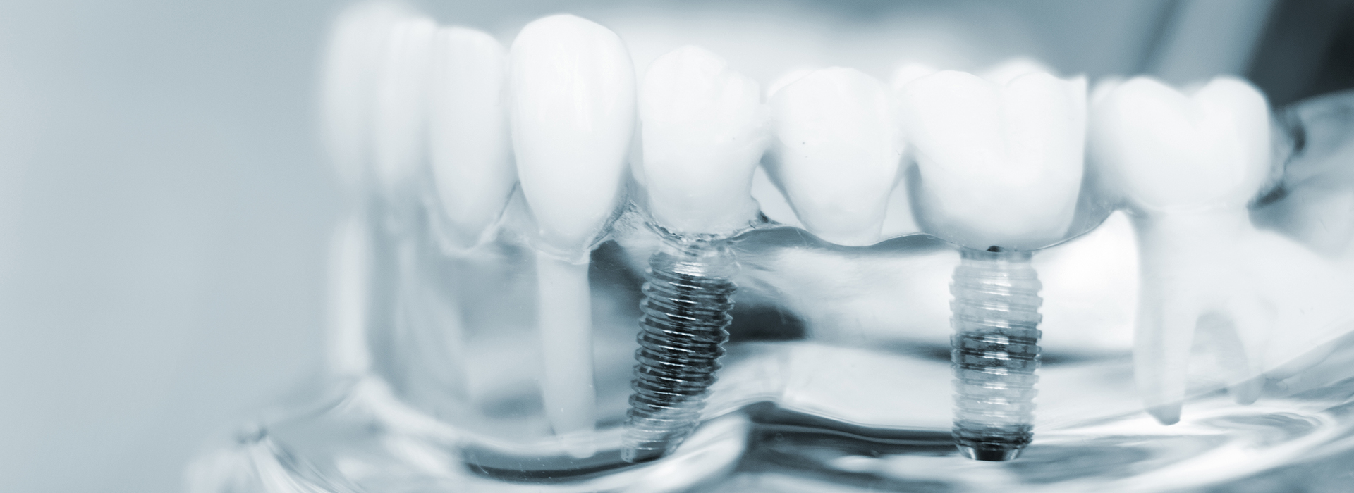 The image shows a close-up view of dental implants with screws and abutments, placed on a transparent surface against a blurred background.